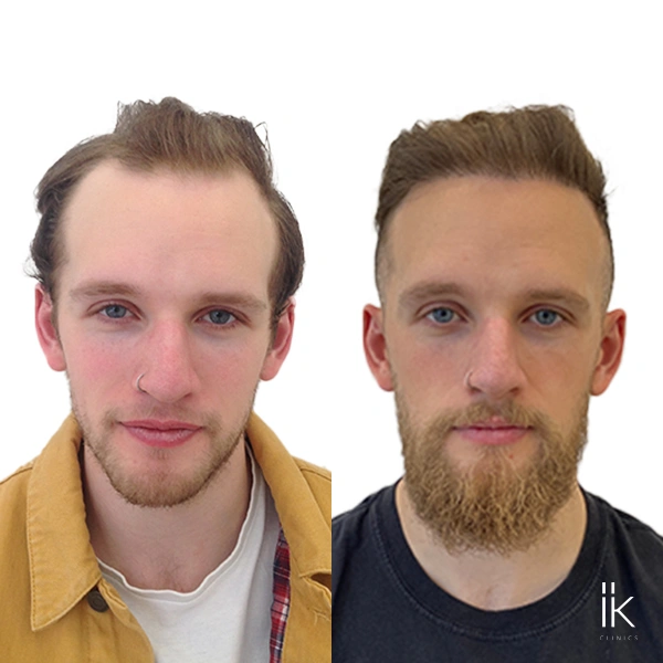 Before and after hair transplant