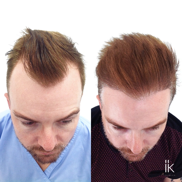 Before and after hair transplant