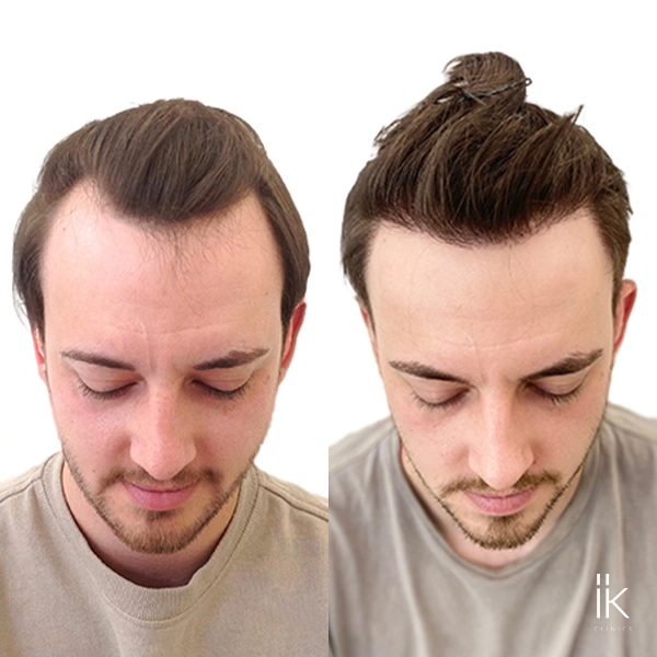 Before and after hair transplant