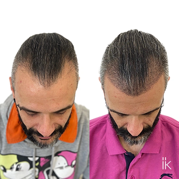 Before and after hair transplant