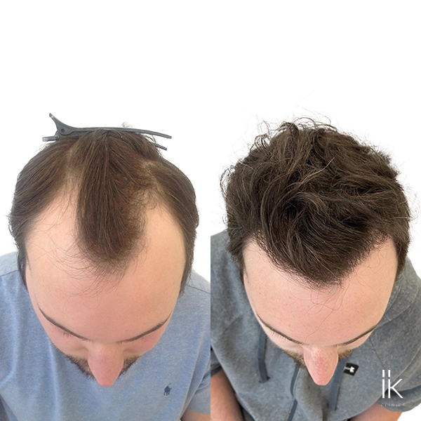 Before and after hair transplant