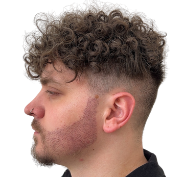 Side view after beard transplant on curly hair