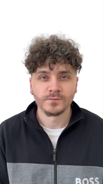 curly hair after beard transplant