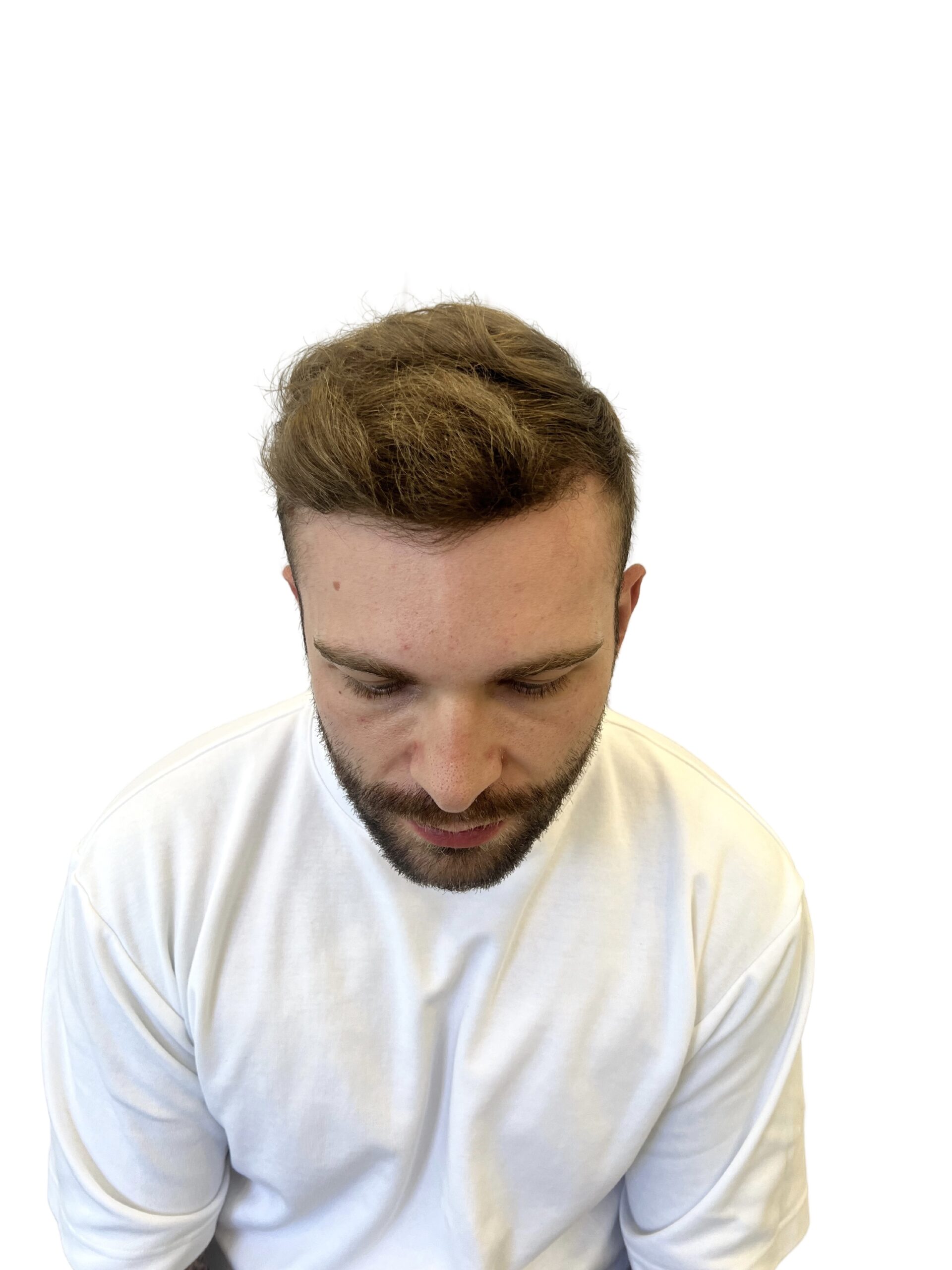 Male Client showing off full head of hair after a hair transplant treatment