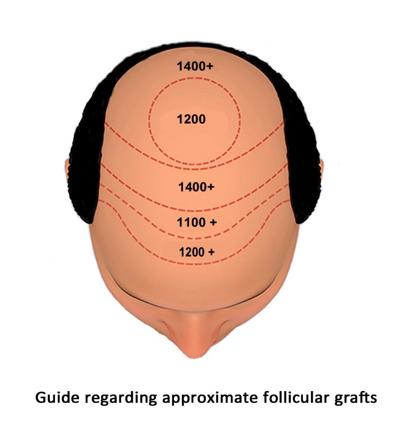 male hair loss treatment