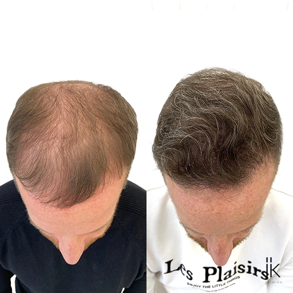 Before and After of a Patients hair transplant