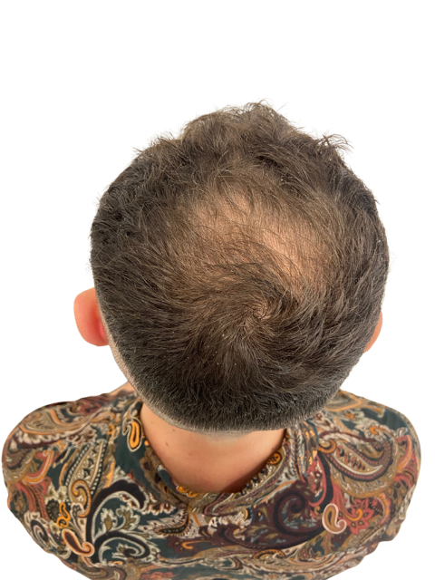 Displaying hair loss on a Male