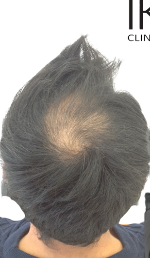 Top view of a hair thinning on the crown