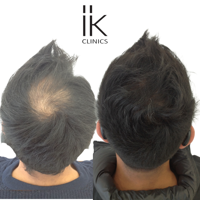 Top view of a hair restoration treatment of a balding spot