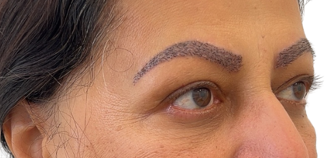 Image of a patients Eyebrows - CLOSE UP