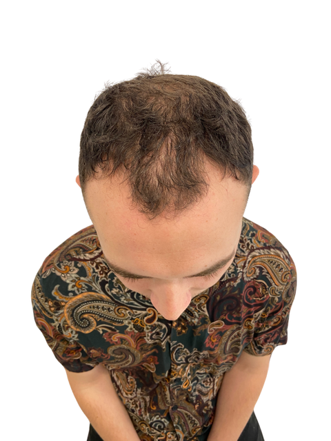 image of another male with a receding hair line