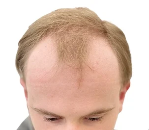 An example Image of hair loss