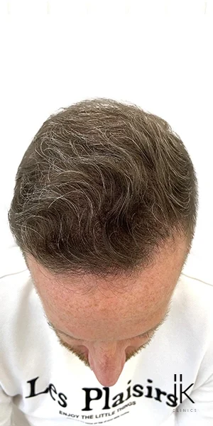 An image of a clients hair restoration before and after journey