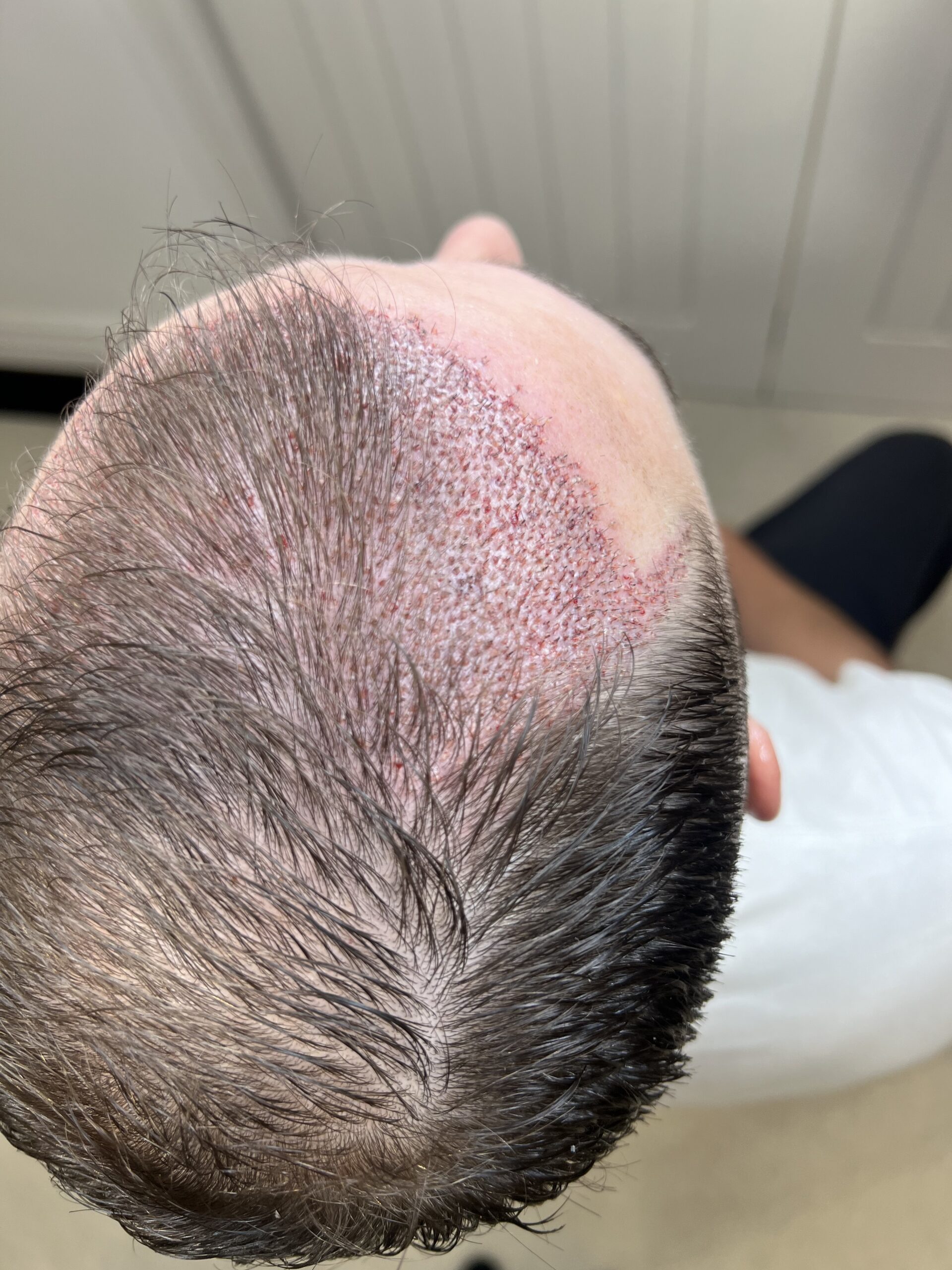 Image of a hair transplant to treat a receding hairline