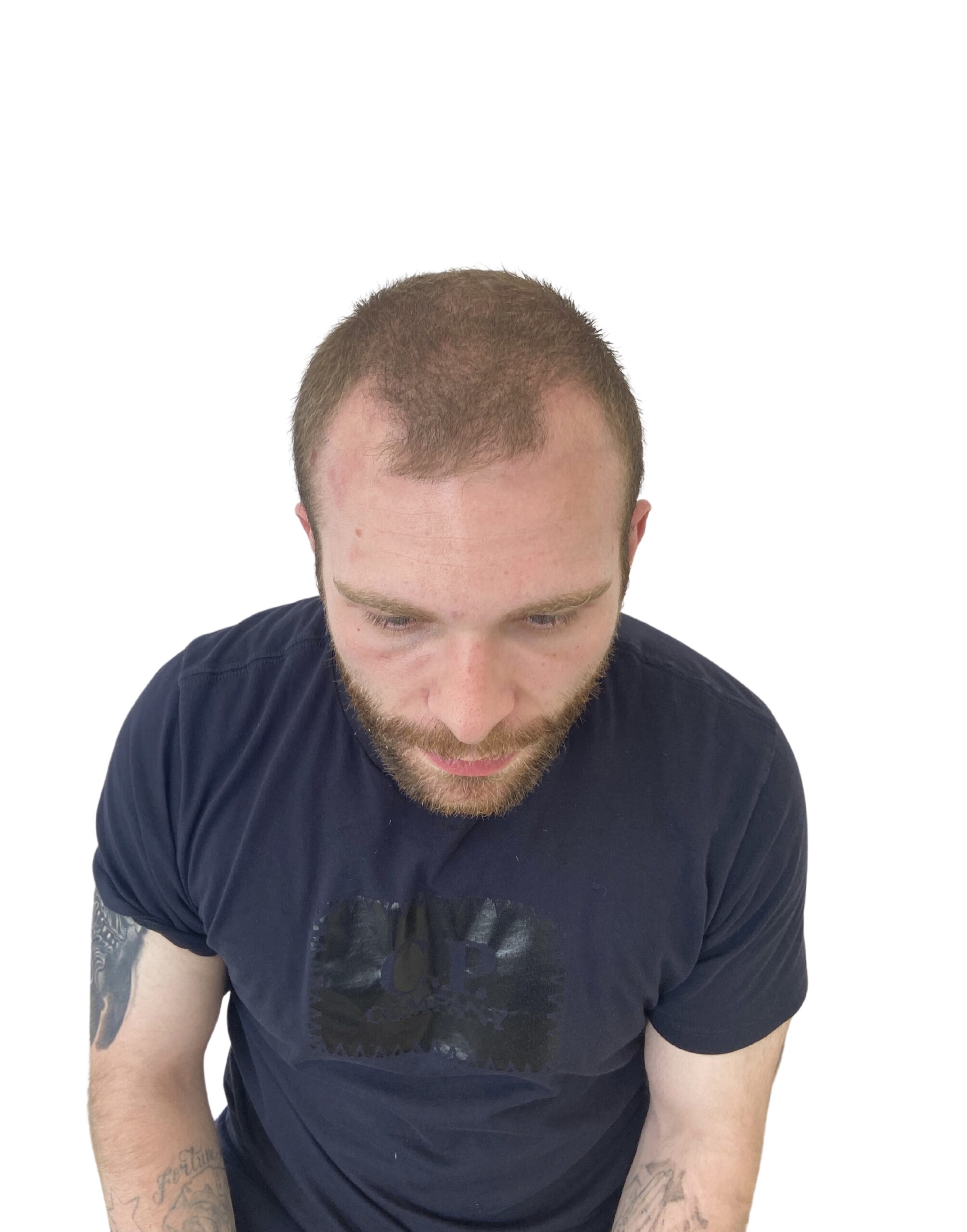 image of a male with a receeding hairline