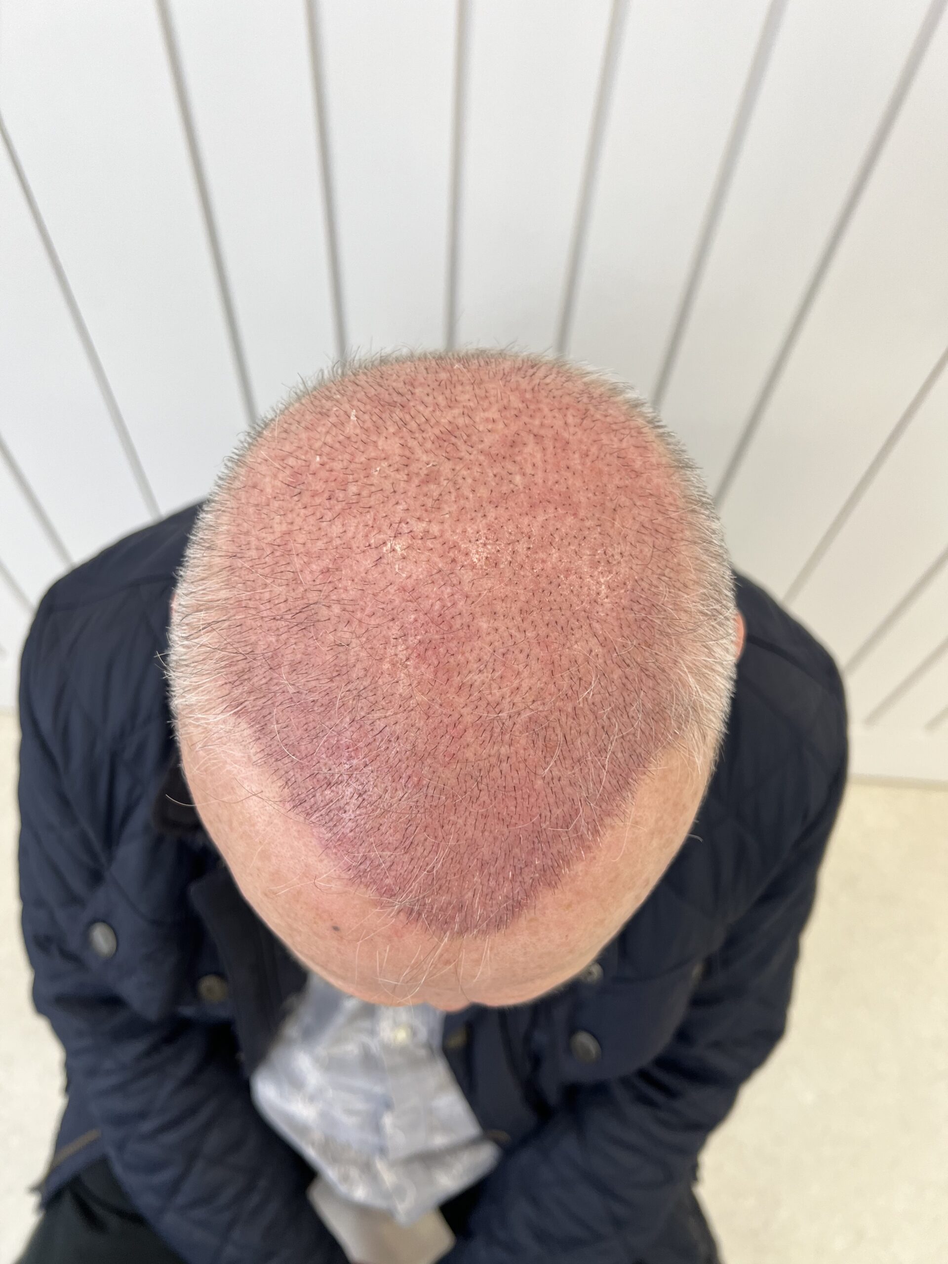 Image of a patients newly performed Hair Transplant