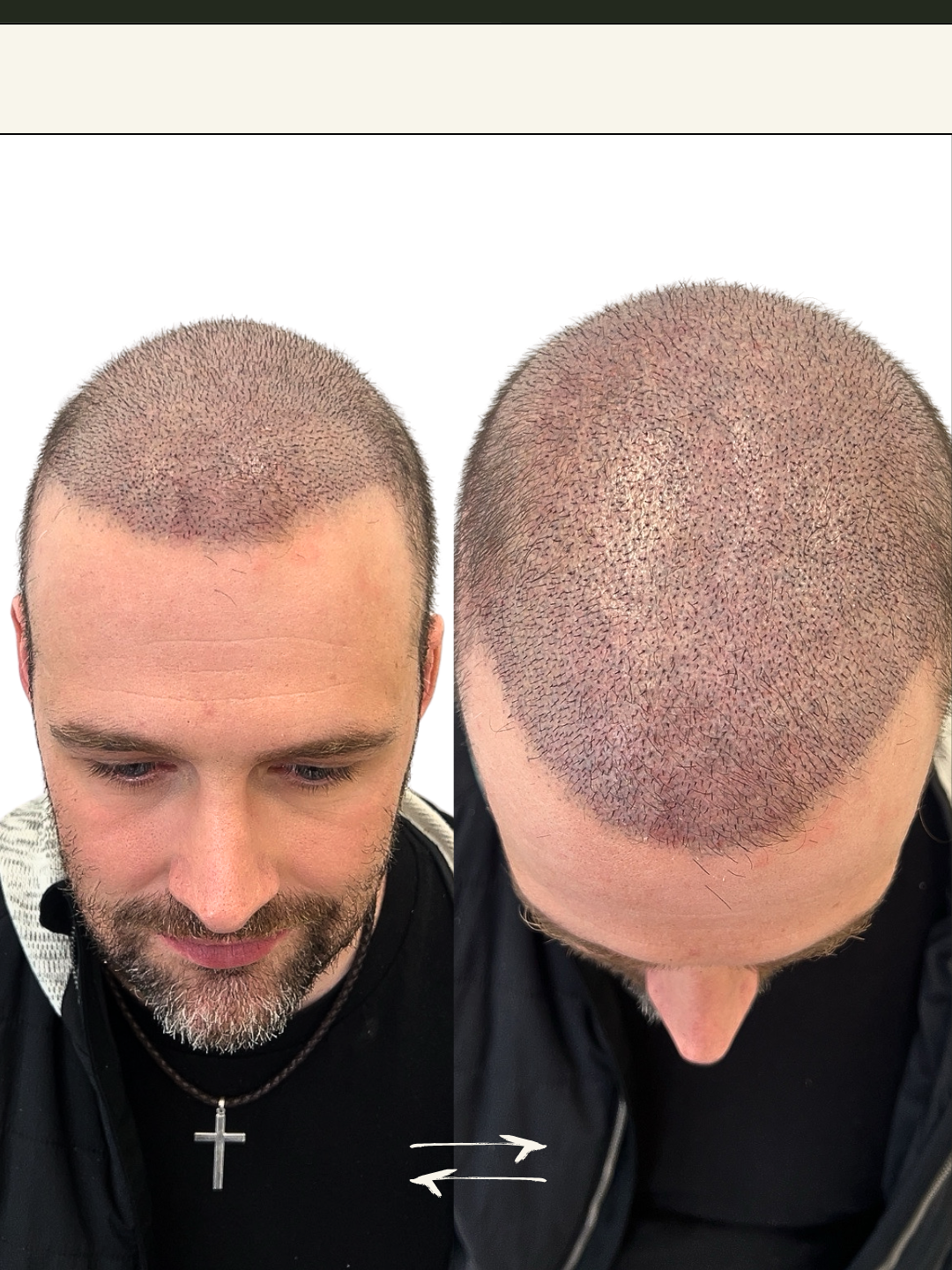 An image of a client that demonstrates the after of the FUE Technique