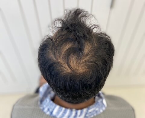 Image of a client showing signs of hair loss/crown balding