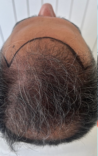 Image of a marked out hairline for before treatment