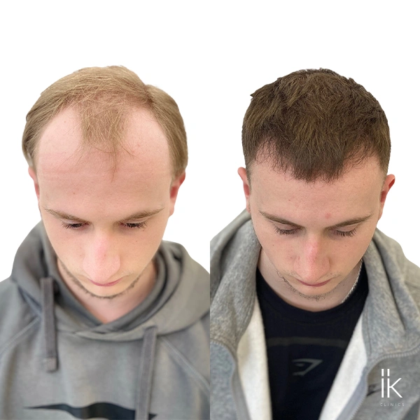 Image before and after a hair transplant on thin hair