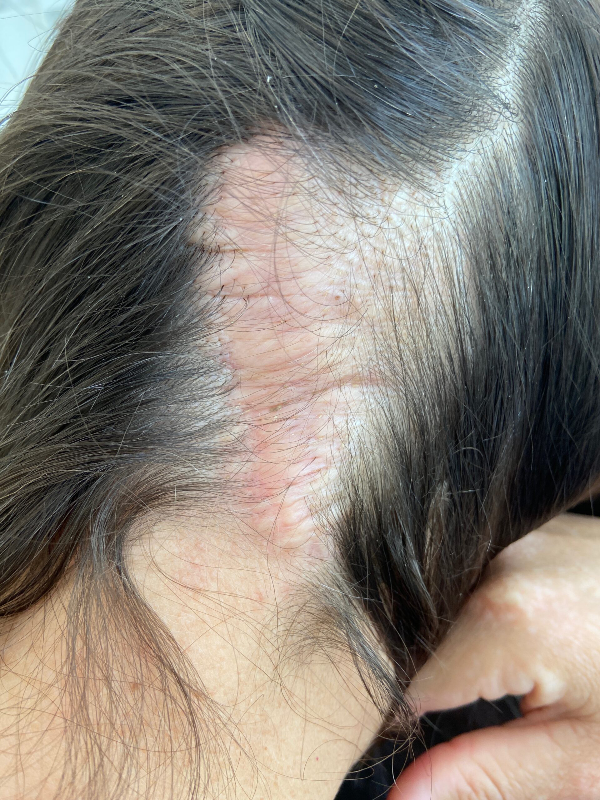 Image of a scar on the head before a hair transplant to cover it