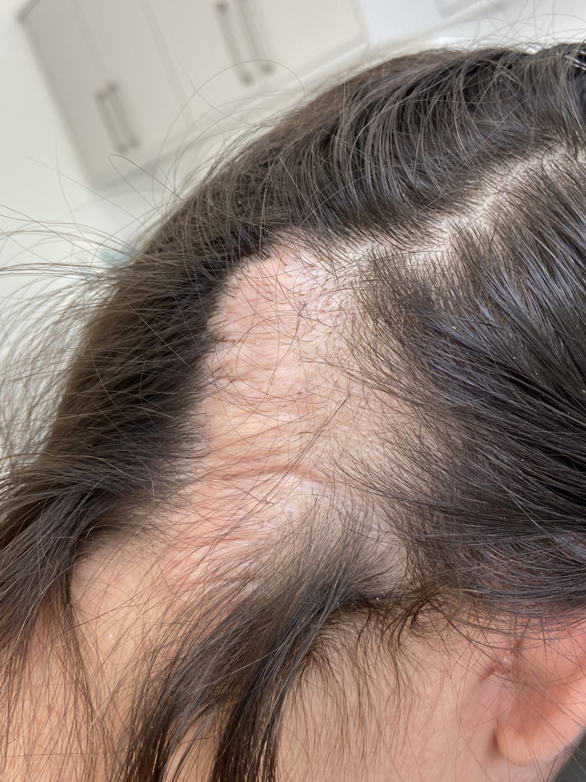 Another image of a scar on the scalp before a hair transplant to cover it