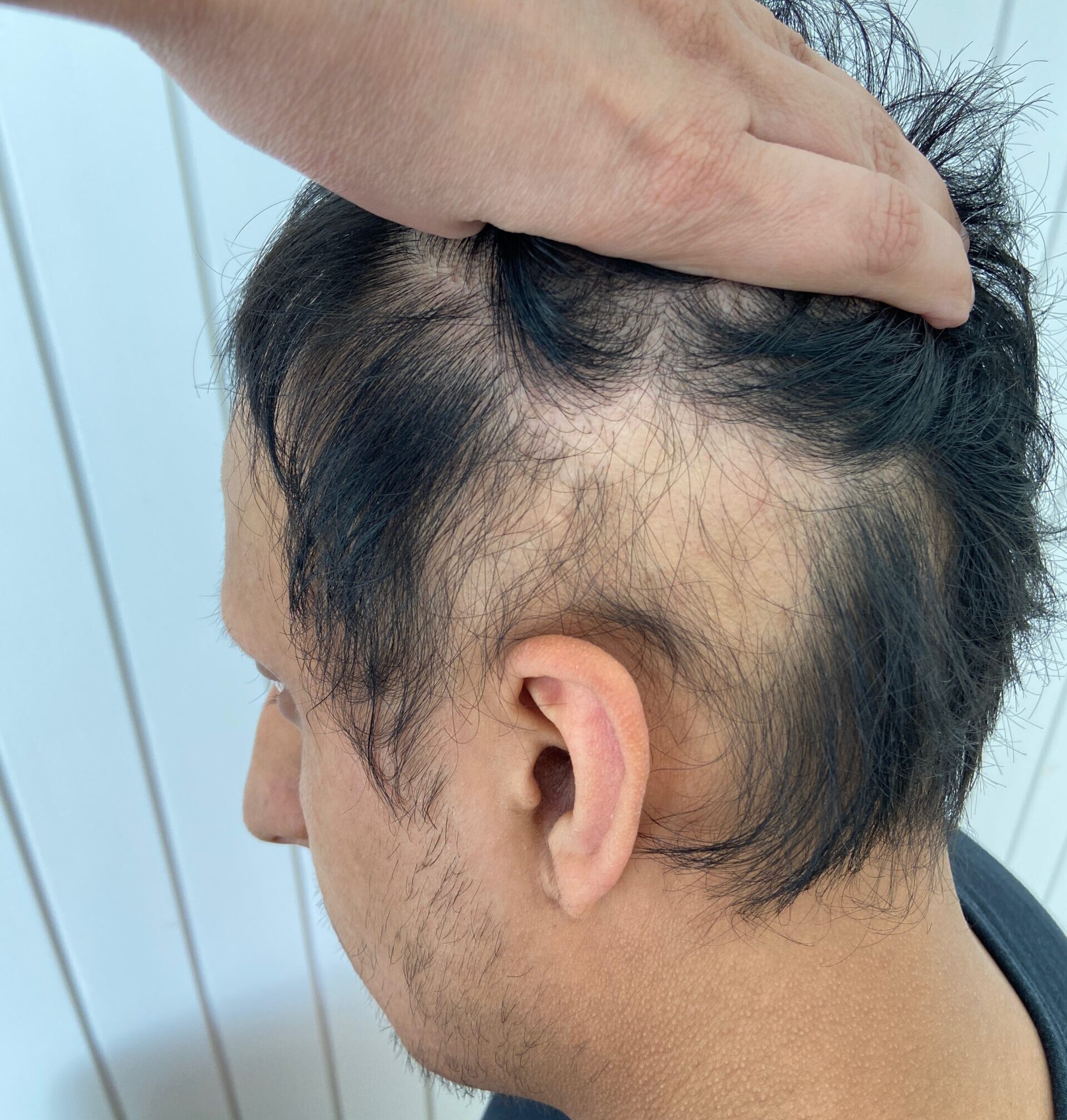 Image of a client with Alopecia Areata above the ear