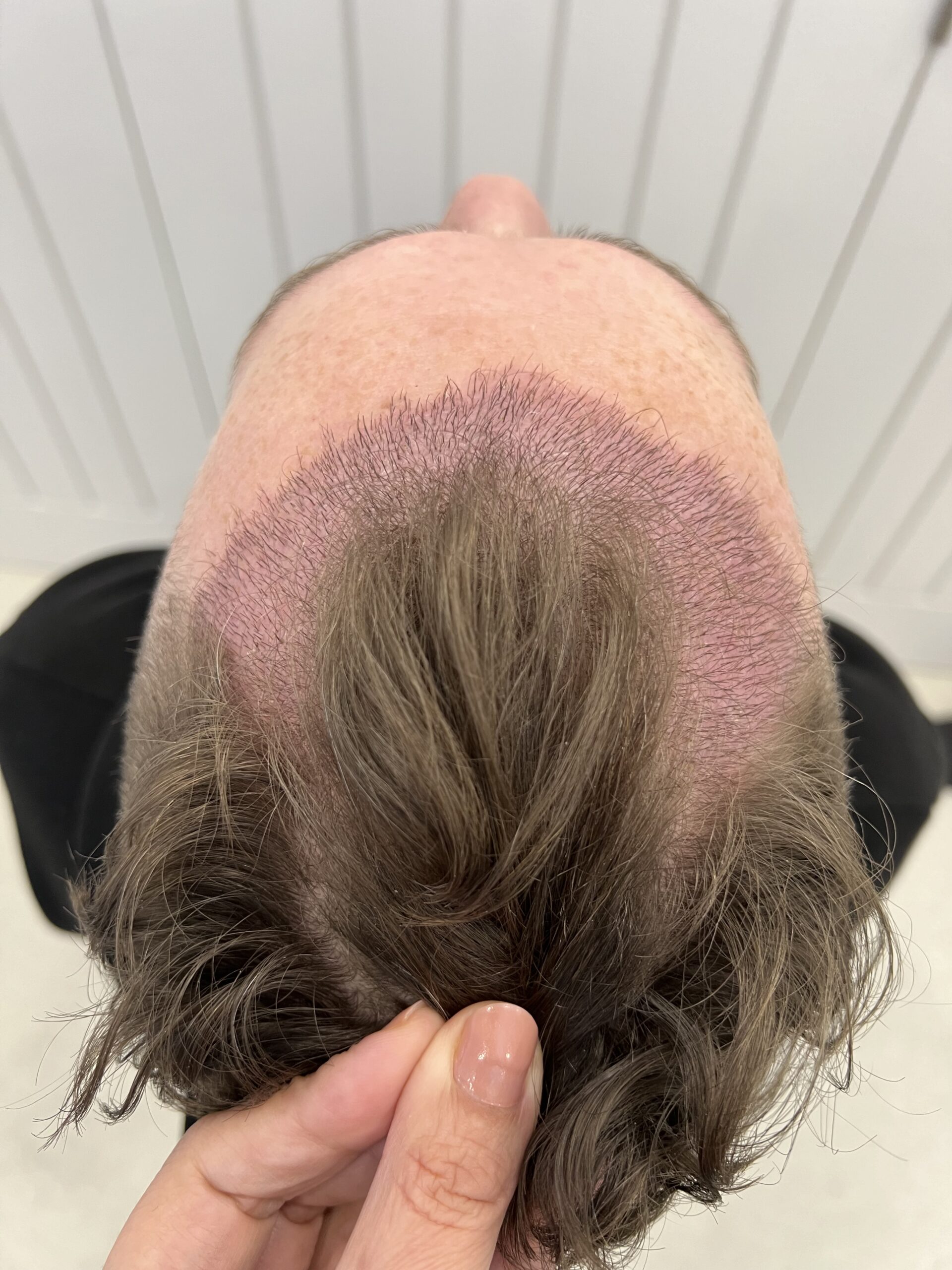 Top image of what a hair transplant looks like after completed