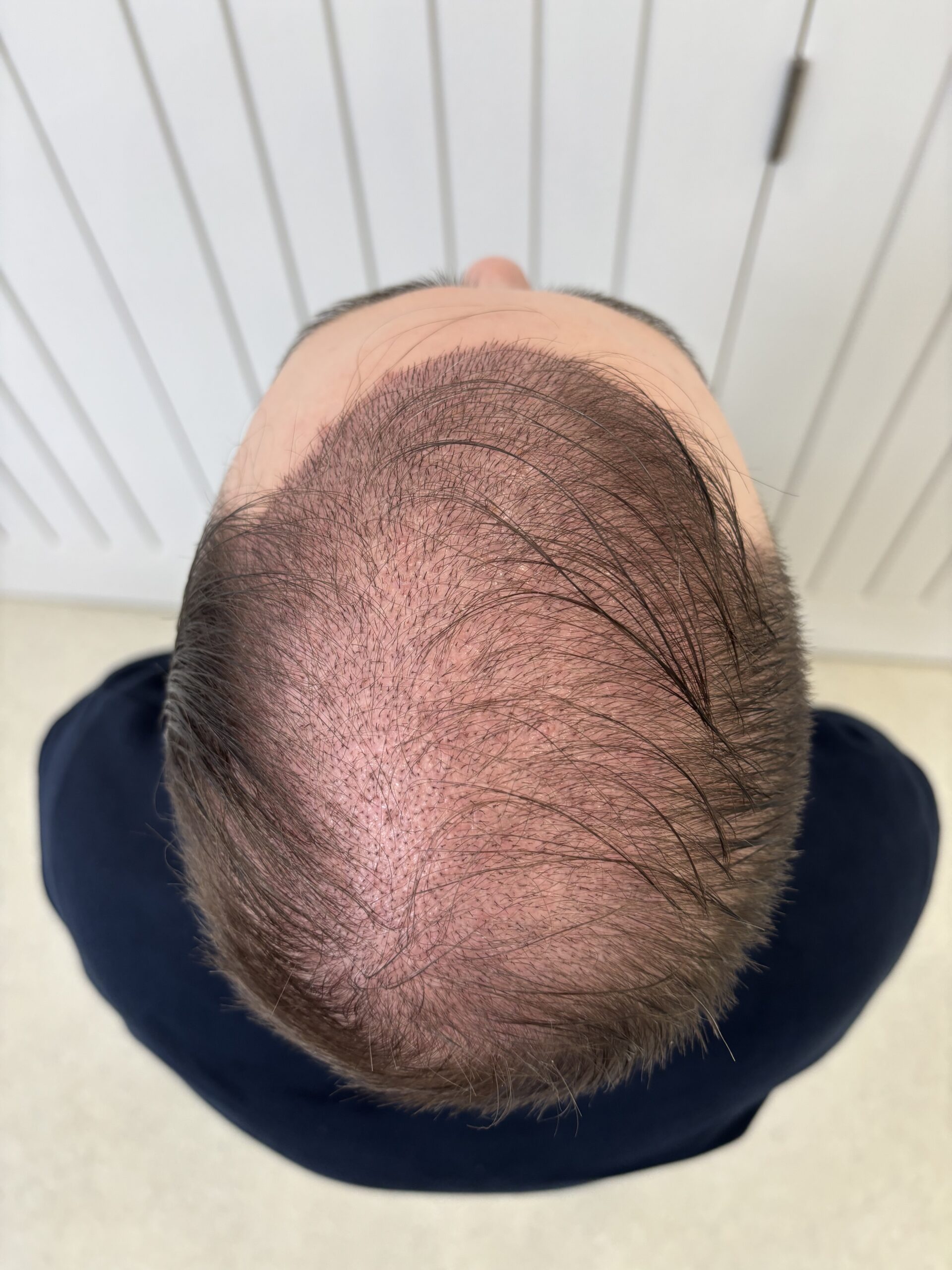 Starting to see some hair growth after a hair transplant procedure